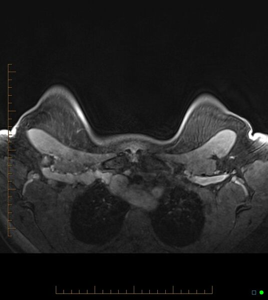 File:Axillary lymphadenopathy on breast MRI- yellow fever vaccination induced (Radiopaedia 19454-19483 Axial T1 C+ fat sat 9).jpg