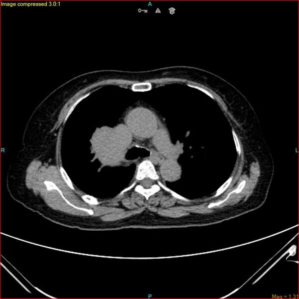 File:Azygos vein aneurysm (Radiopaedia 77824-90130 A 25).jpg