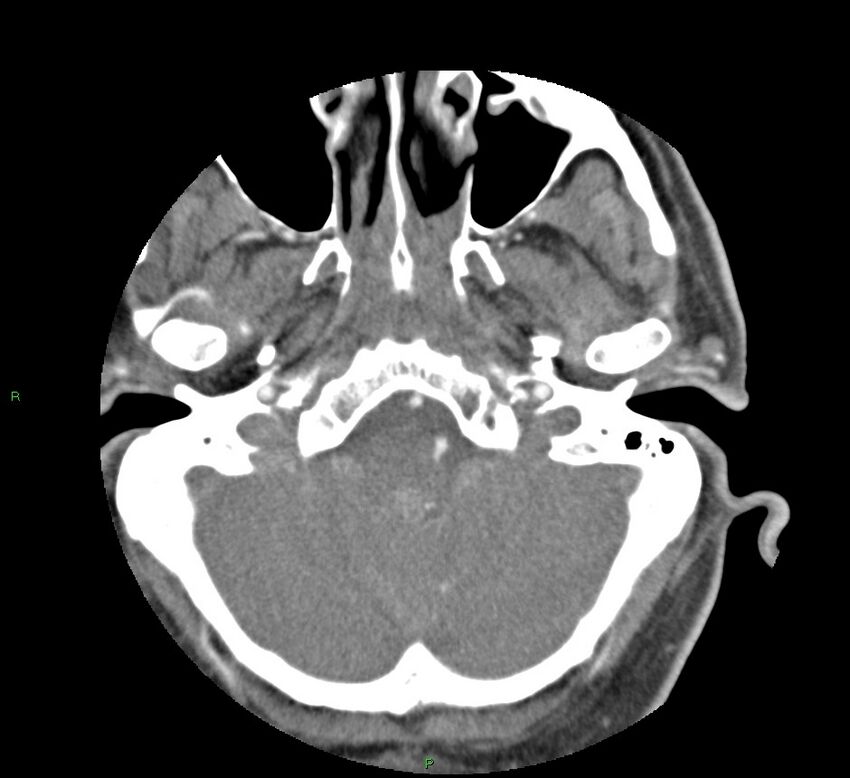 Basal ganglia hemorrhage (Radiopaedia 58763-65985 D 33).jpg