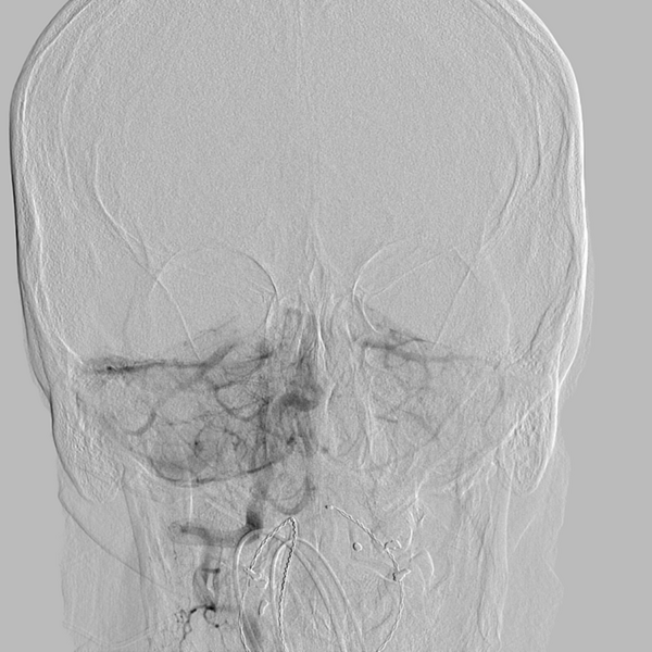 File:Basilar artery occlusion (Radiopaedia 33570-34668 RT VERT IC 23).png