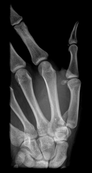 File:Bennett fracture (Radiopaedia 55586-62085 Oblique 1).png
