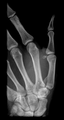 Bennett fracture (Radiopaedia 55586-62085 Oblique 1).png