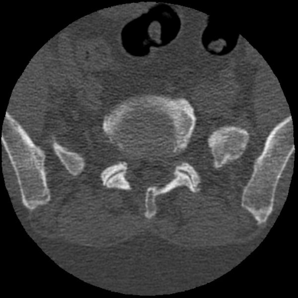 File:Bertolotti syndrome (Radiopaedia 24864-25128 Axial bone window 27).jpg