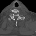 Bilateral C6-7 locked facet dislocation (Radiopaedia 28506-28748 Axial bone window 27).jpeg