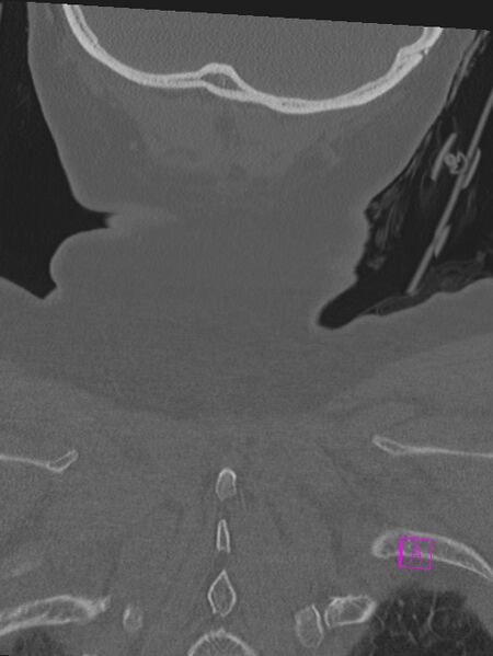 File:Bilateral atlanto-occipital assimilation (Radiopaedia 28350-28603 Coronal bone window 52).jpg