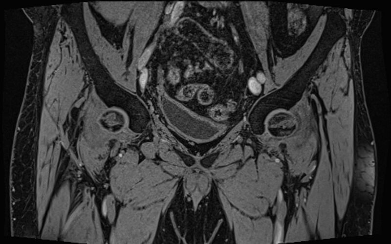 File:Bilateral avascular necrosis of femoral head (Radiopaedia 77116-89078 Coronal T2 we 69).jpg