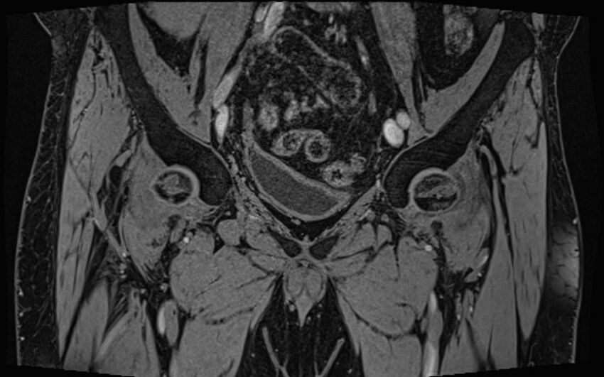 Bilateral avascular necrosis of femoral head (Radiopaedia 77116-89078 Coronal T2 we 69).jpg