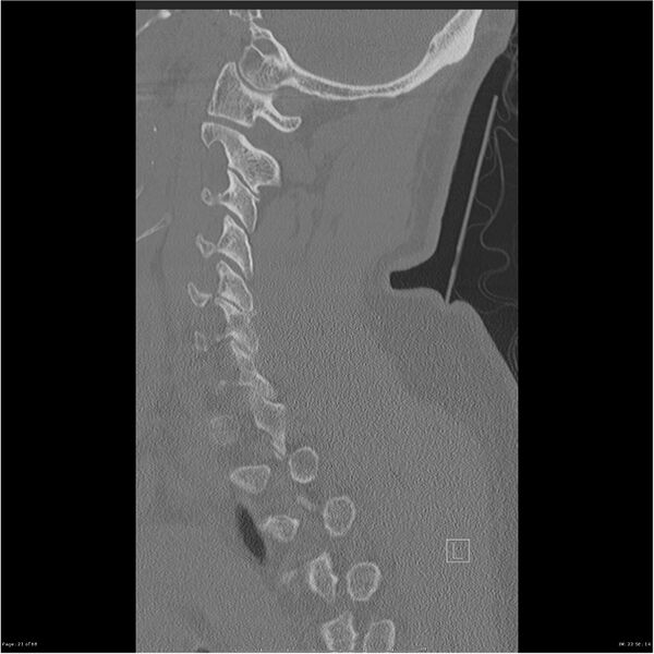 File:Bilateral cervical ribs (Radiopaedia 25868-26017 Sagittal bone window 21).jpg