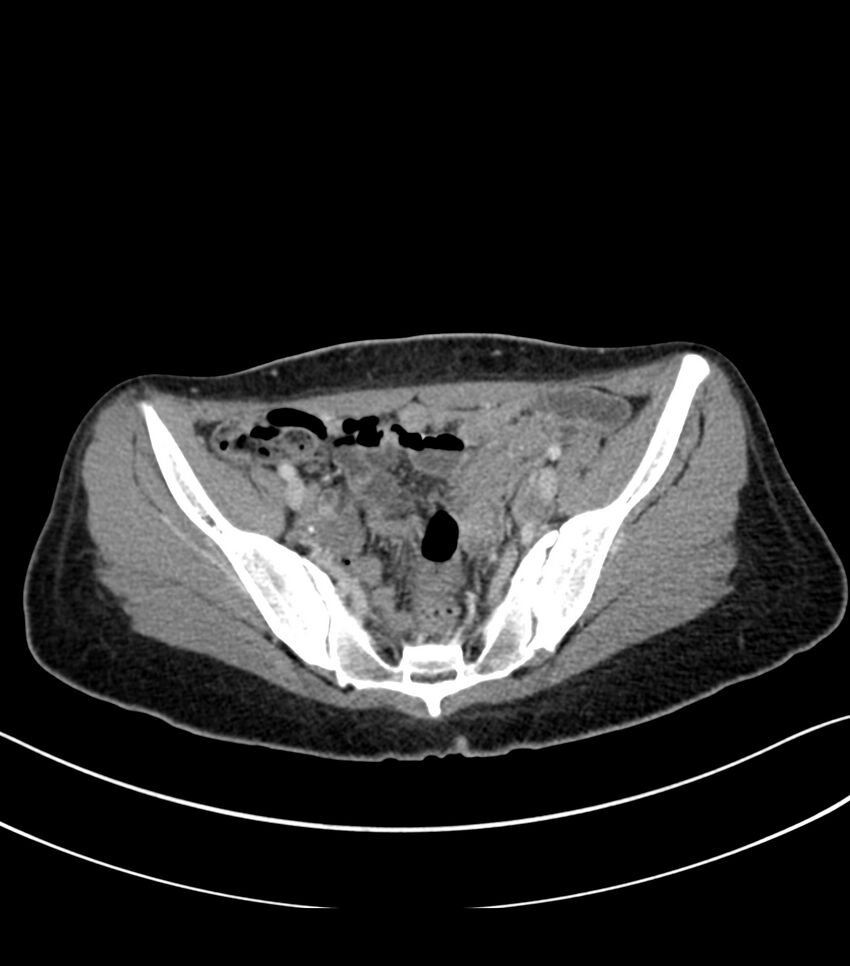 Bilateral kidney malrotation (Radiopaedia 72227-82749 A 56).jpg