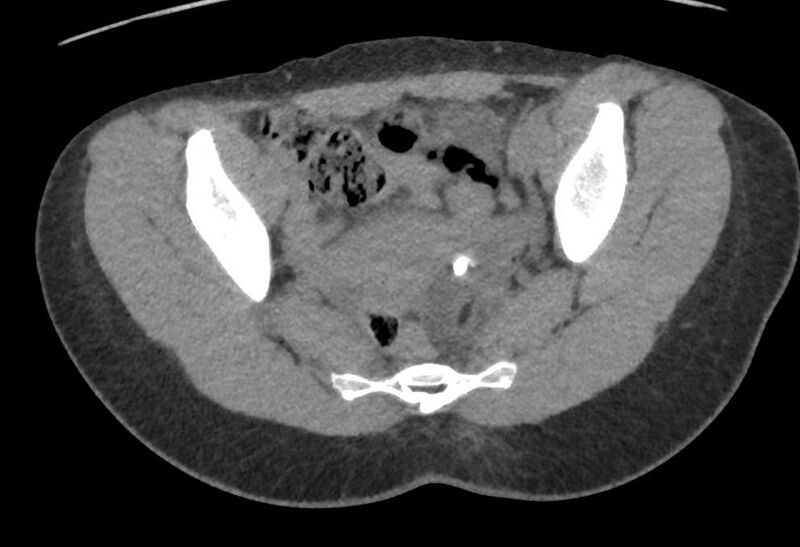 File:Bilateral mature cystic ovarian teratoma (Radiopaedia 88821-105592 Axial non-contrast 17).jpg