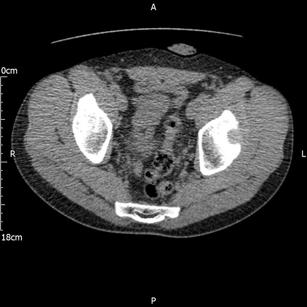 File:Bilateral medullary nephrocalcinosis with ureteric calculi (Radiopaedia 71269-81569 Axial non-contrast 117).jpg