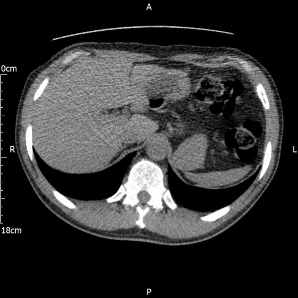 File:Bilateral medullary nephrocalcinosis with ureteric calculi (Radiopaedia 71269-81569 Axial non-contrast 18).jpg