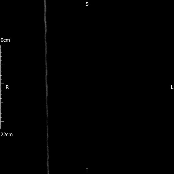 File:Bilateral medullary nephrocalcinosis with ureteric calculi (Radiopaedia 71269-81569 Coronal non-contrast 1).jpg