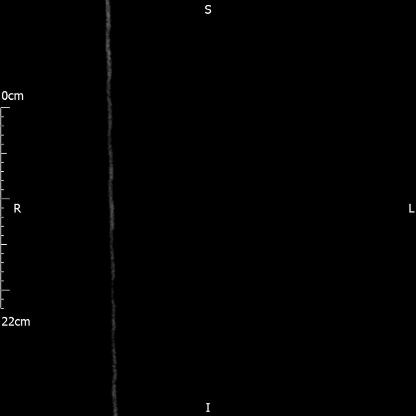 Bilateral medullary nephrocalcinosis with ureteric calculi (Radiopaedia 71269-81569 Coronal non-contrast 1).jpg