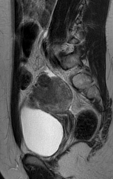 File:Bilateral ovarian fibrothecomas - adolescent (Radiopaedia 86604-102707 Sagittal T2 22).jpg