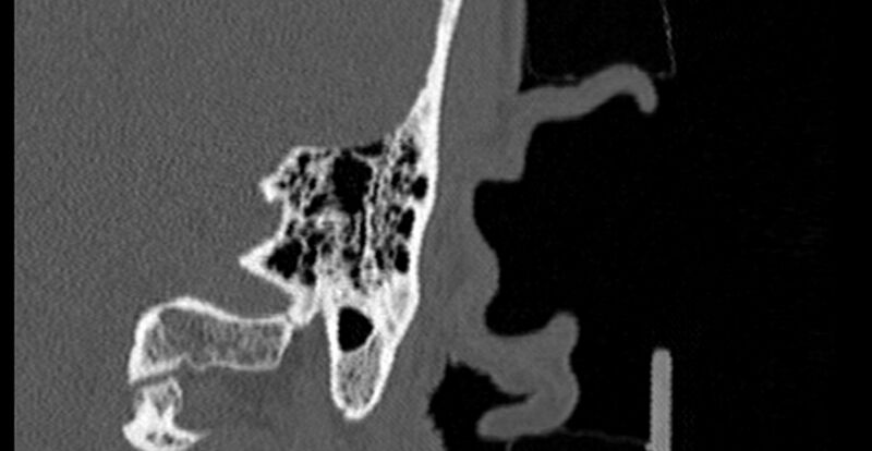 File:Bilateral temporal bone fractures (Radiopaedia 29482-29970 B 78).jpg