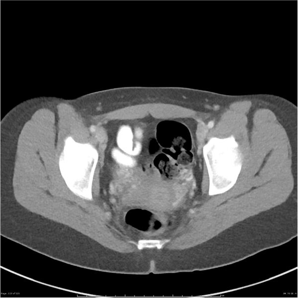 File:Bilateral ureteritis and cystitis (Radiopaedia 25340-25594 A 70).jpg