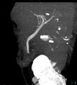 Bile leak from accessory duct(s) of Luschka post cholecystectomy (Radiopaedia 40736-43389 D 30).jpg