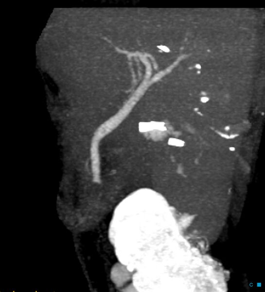 File:Bile leak from accessory duct(s) of Luschka post cholecystectomy (Radiopaedia 40736-43389 D 30).jpg
