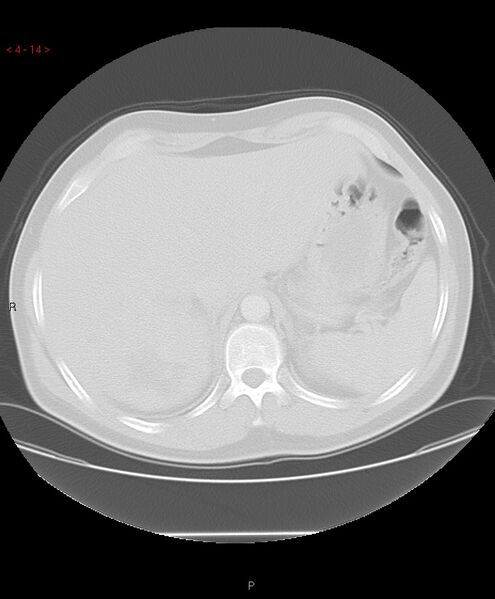 File:Birt-Hogg-Dubé syndrome (Radiopaedia 53814-60013 Axial lung window 14).jpg