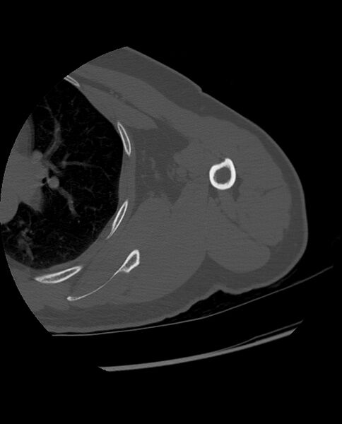 File:Bizarre parosteal osteochondromatous proliferation (Radiopaedia 84221-99501 Axial bone window 27).jpg
