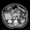 Bladder papillary urothelial carcinoma (Radiopaedia 48119-52951 Axial 16).png