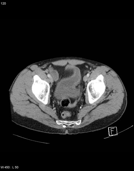 File:Boerhaave syndrome with tension pneumothorax (Radiopaedia 56794-63603 A 60).jpg