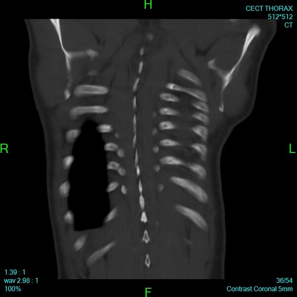 File:Bone metastases from lung carcinoma (Radiopaedia 54703-60937 Coronal bone window 36).jpg
