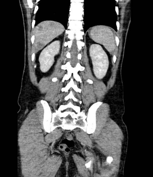 File:Bowel obstruction from colon carcinoma (Radiopaedia 22995-23028 C 59).jpg