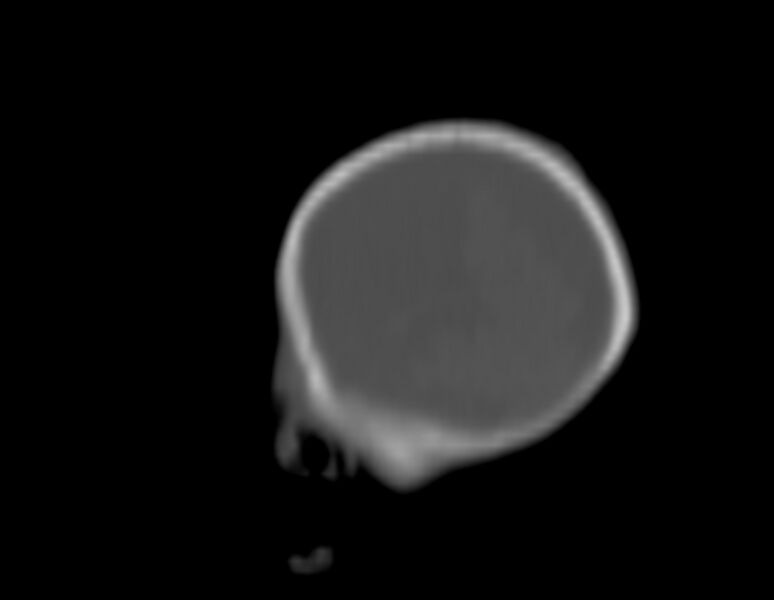 File:Brachycephaly (bi-coronal and bi-lambdoid synostosis) (Radiopaedia 55048-61413 Sagittal bone window 29).jpg