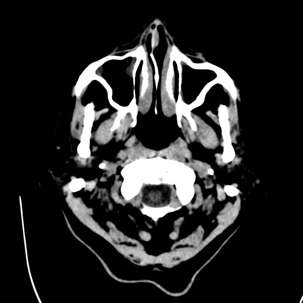 File:Brain Pantopaque remnants (Radiopaedia 78403-91048 Axial non-contrast 12).jpg