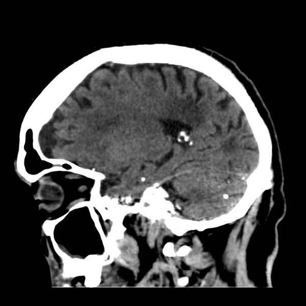 File:Brain Pantopaque remnants (Radiopaedia 78403-91048 C 20).jpg