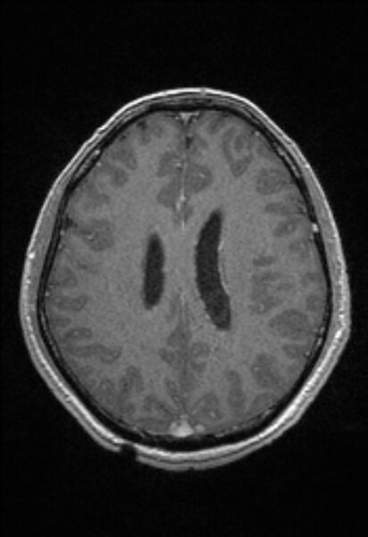 File:Brain abscess with ventriculitis (Radiopaedia 85703-101495 Axial T1 C+ 117).jpg