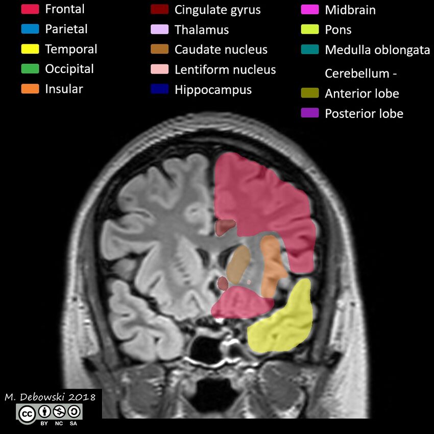 Brain lobes - annotated MRI (Radiopaedia 61691-69700 Coronal 23).JPG
