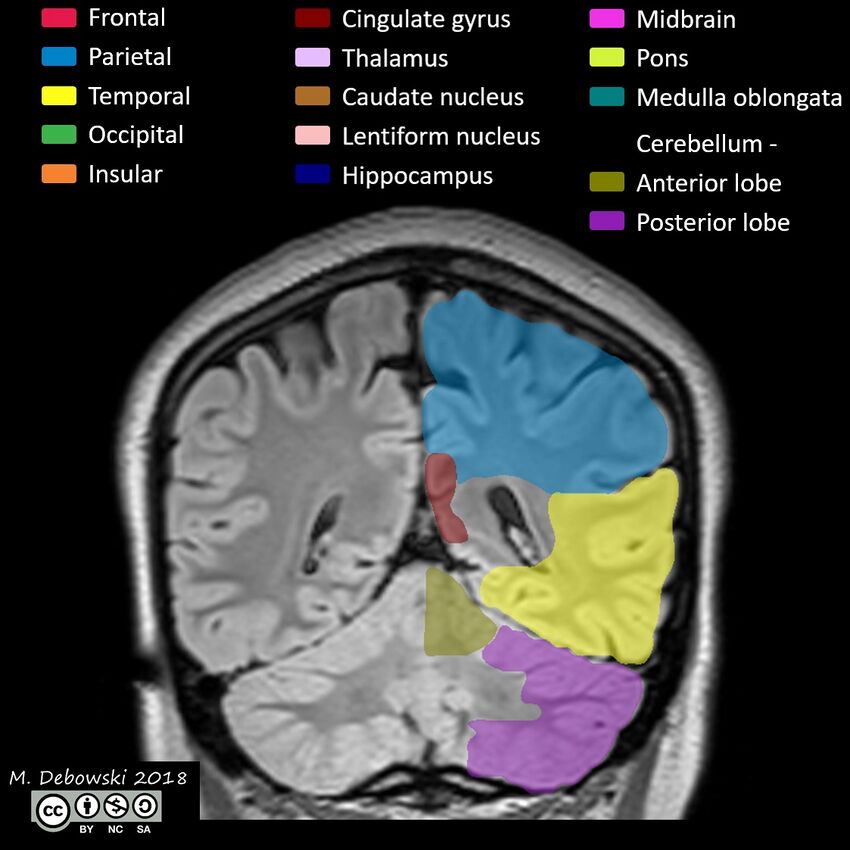 Brain lobes - annotated MRI (Radiopaedia 61691-69700 Coronal 51).JPG