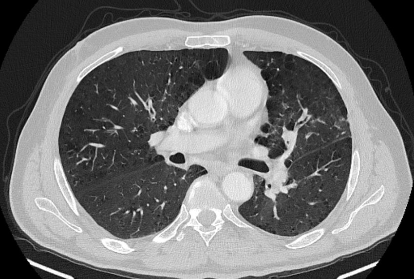 Brain metastases - lung cancer primary (Radiopaedia 75060-86116 Axial lung window 27).jpg