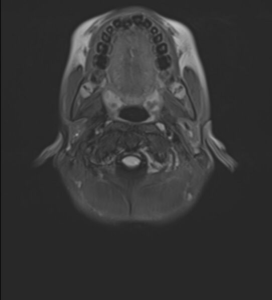File:Brainstem glioma (Radiopaedia 70548-80674 Axial FLAIR 1).jpg