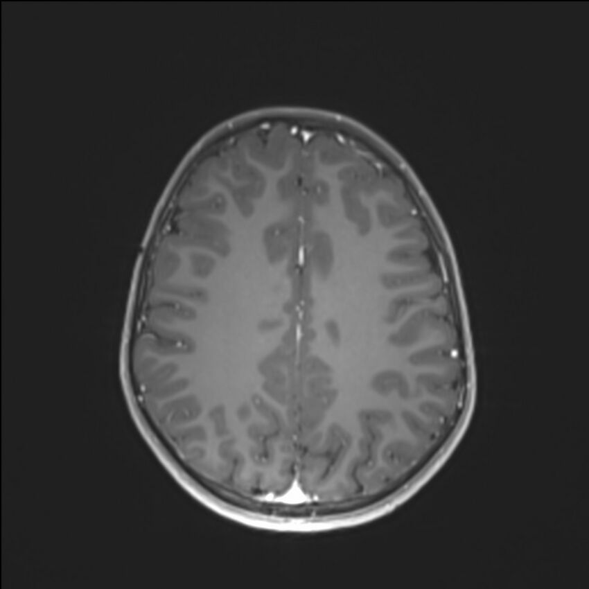 Brainstem glioma (Radiopaedia 70548-80674 Axial T1 C+ 109).jpg