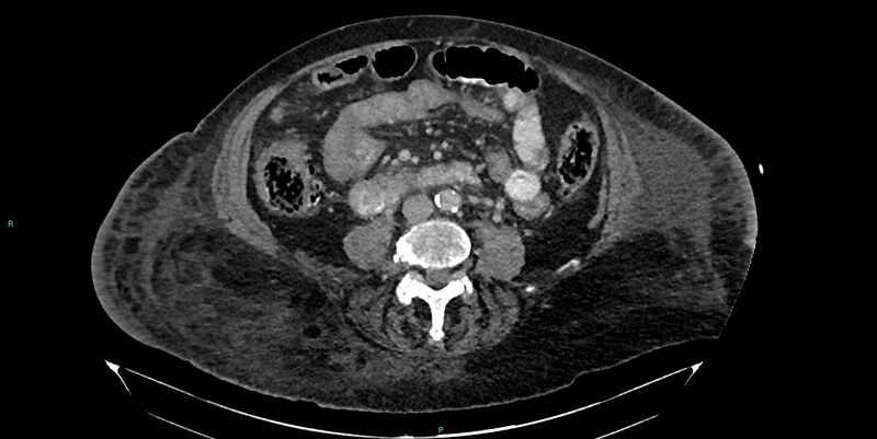 File:Breast cancer pelvic bony metastases (Radiopaedia 84470-99824 Axial bone window 11).jpg