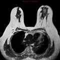 Breast carcinoma (multicentric multifocal in mammary Paget disease) (Radiopaedia 50966-56512 Axial T2 12).jpg
