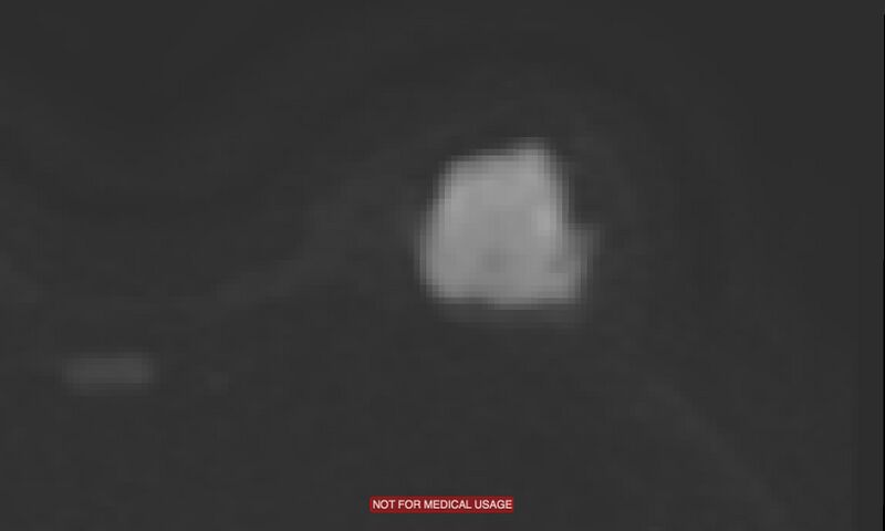 File:Breast lymphoma (MRI) (Radiopaedia 34999-36498 Axial DWI 6).jpg