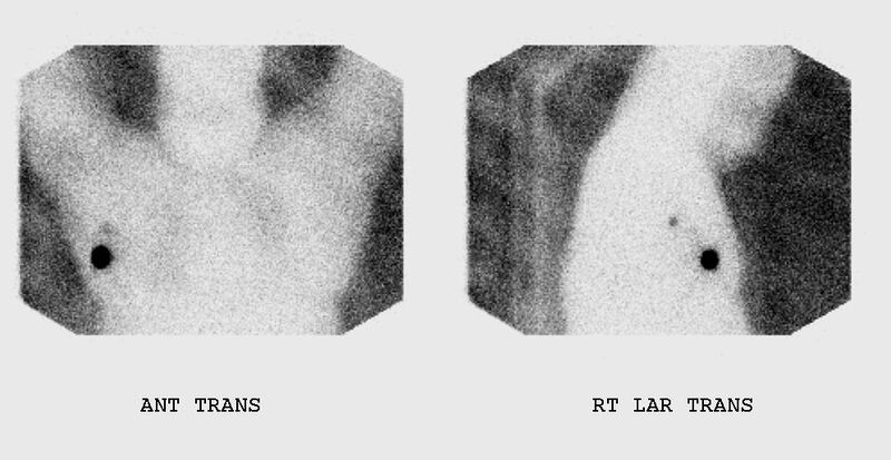 File:Breast lymphoscintigraphy (Radiopaedia 11254).jpg