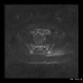 Broad ligament fibroid (Radiopaedia 49135-54241 Axial DWI 14).jpg