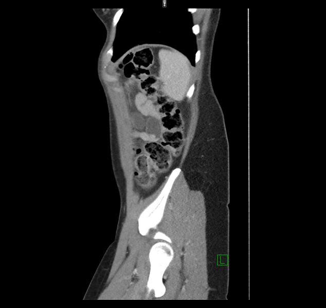 File:Broad ligament hernia (Radiopaedia 63260-71832 C 47).jpg
