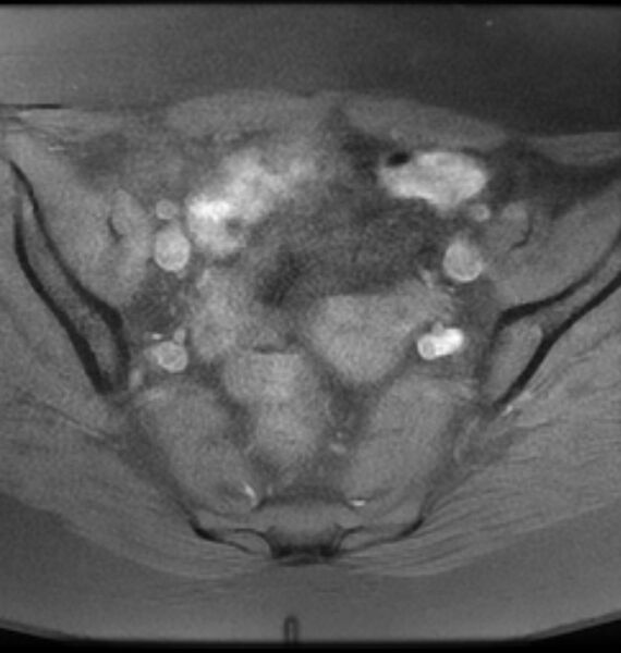 File:Broad ligament leiomyoma (Radiopaedia 81634-95516 Axial T1 fat sat 9).jpg
