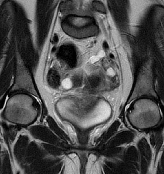 File:Broad ligament leiomyoma (Radiopaedia 81634-95516 Coronal T2 11).jpg