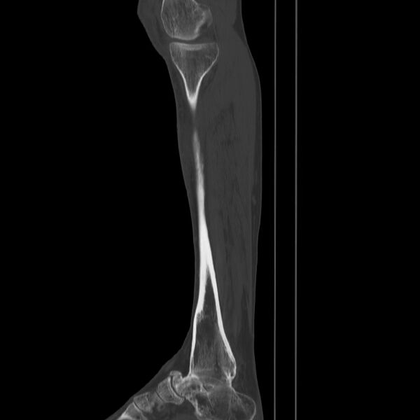 File:Brodie abscess - tibia (Radiopaedia 66028-75204 Sagittal bone window 17).jpg