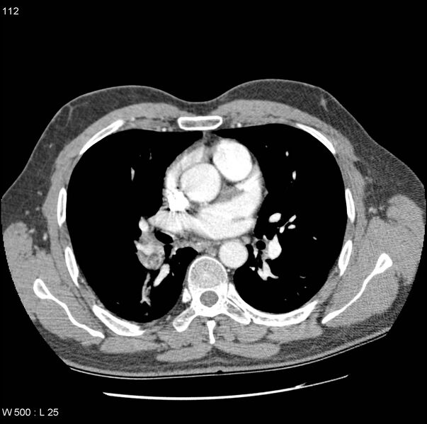 File:Bronchial arterial aneurysm (Radiopaedia 22293-22330 A 7).jpg