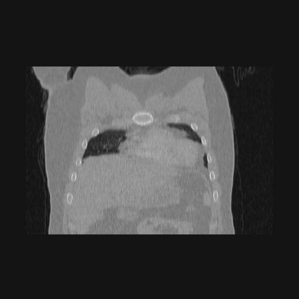 File:Bronchial atresia (Radiopaedia 60685-68439 Coronal lung window 63).jpg