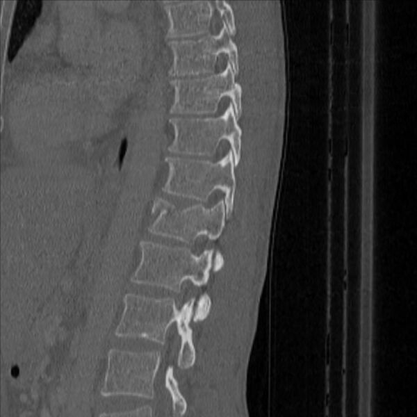 File:Bulging of paraspinal line in traumatic thoracal spinal compression fracture (Radiopaedia 29221-35872 Sagittal bone window 37).jpg